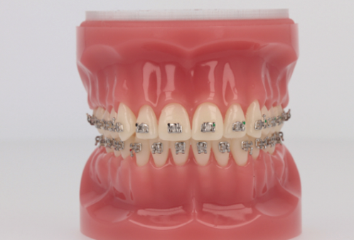 Metal Braces Photo